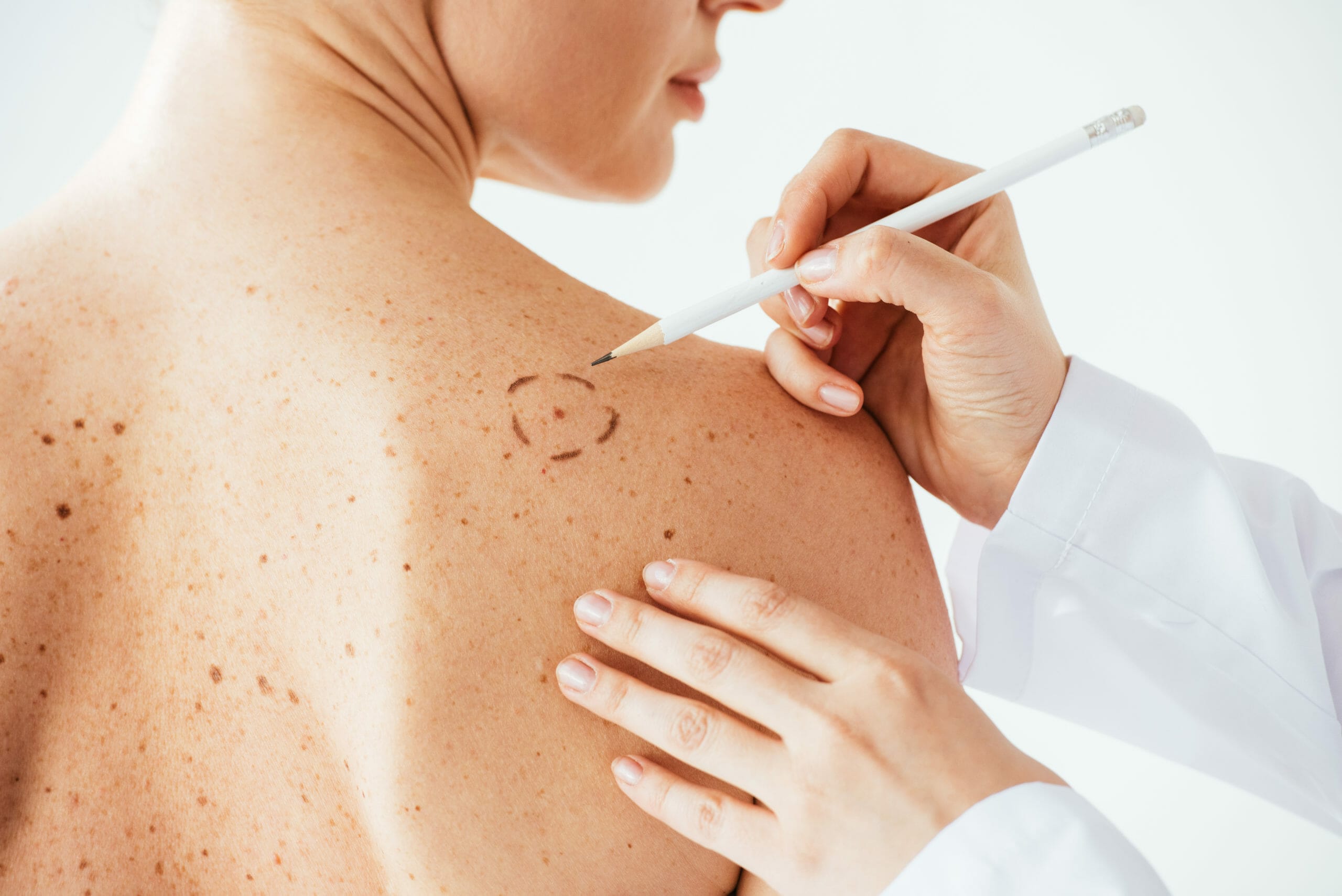 cropped view of dermatologist applying marks on skin of naked woman with melanoma isolated on white